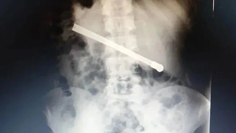 Rosario: un condenado se tragó una bombilla de mate en la cárcel y debieron operarlo